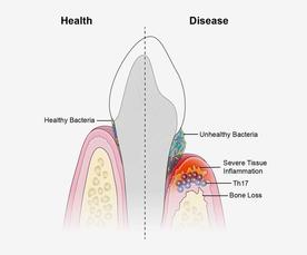 periodontal disease graphic